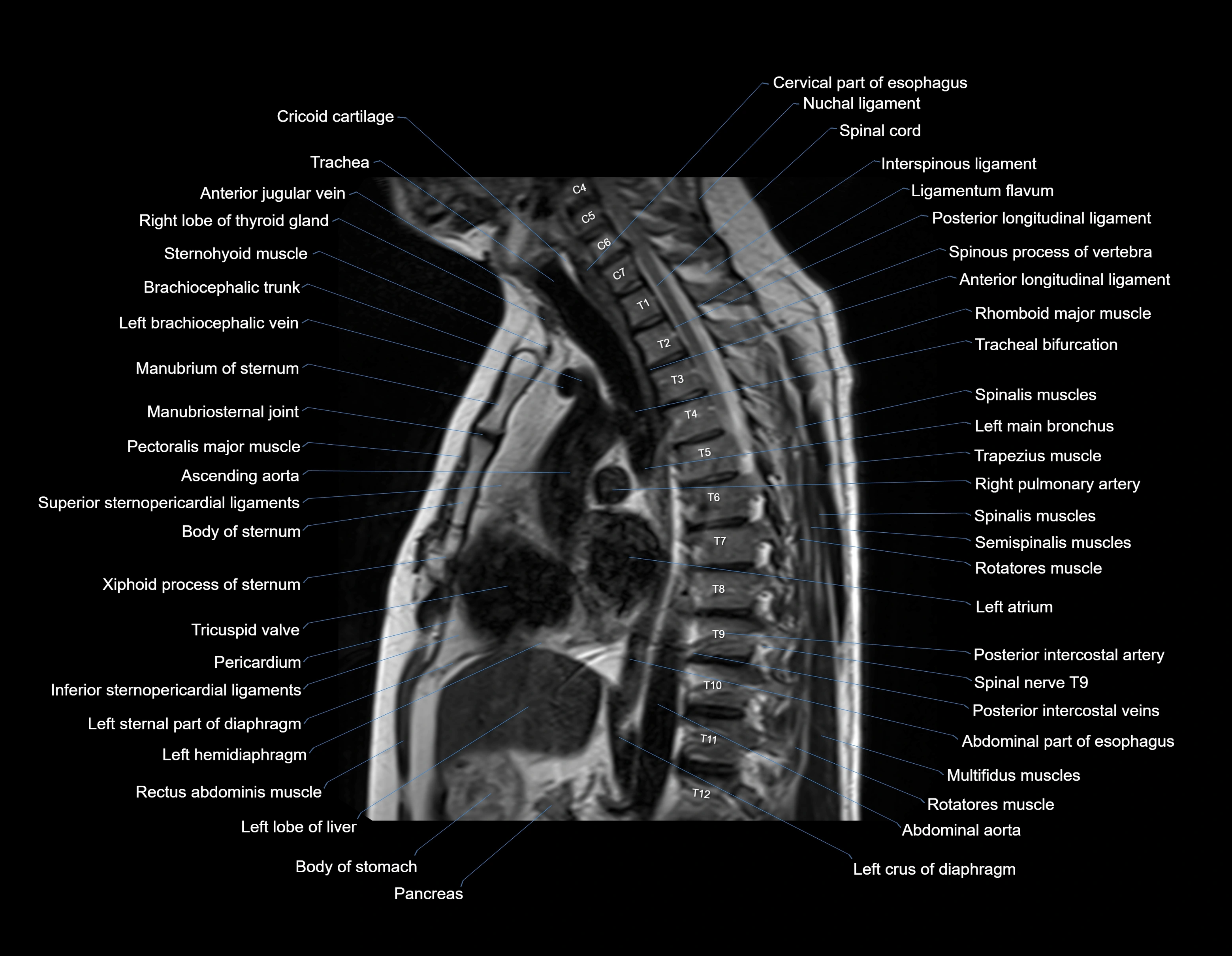 MRI chest (thorax) sagittal labelled cross sectional anatomy 3T radiology image-img-00001-00020.webp
